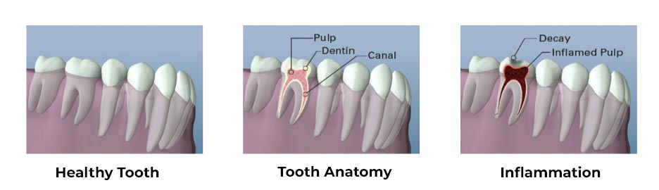 root canal diagram 1