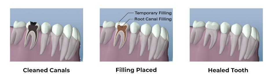 root canal diagram 2